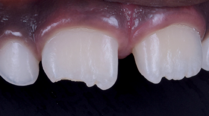 Close-up of upper front teeth with two chipped edges
