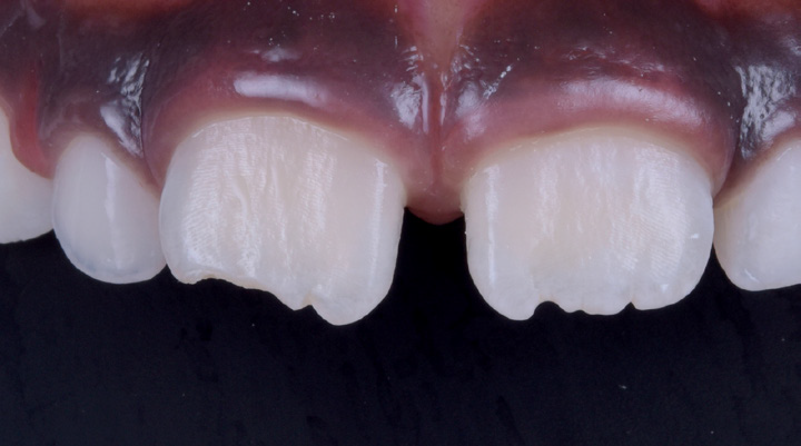 Close-up of upper front teeth with a chipped incisor