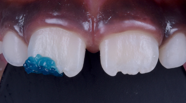 Close-up of upper front teeth with blue dental material applied to one tooth and a chipped adjacent tooth