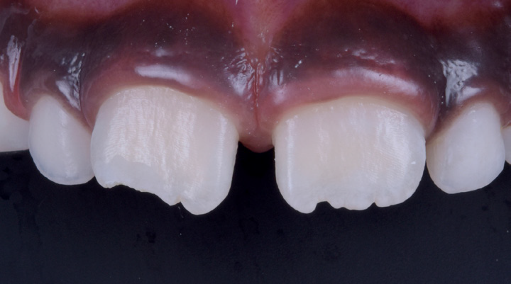 Close-up of upper front teeth with two chipped incisors and visible gums