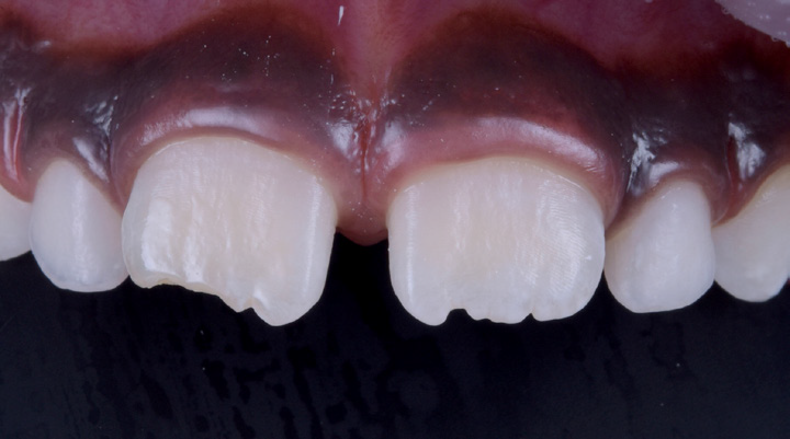 Close-up of upper front teeth with two central incisors chipped