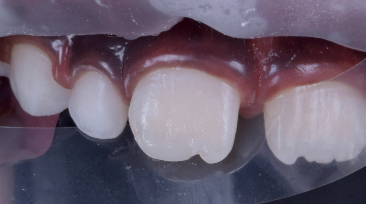 Close-up of upper front teeth with one tooth chipped at the edge