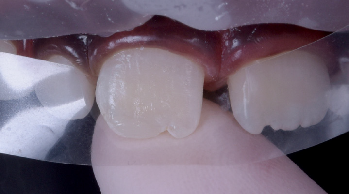 Close-up of upper front teeth showing a chipped central incisor with a dental tool near the gum line