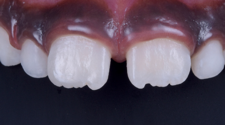 Close-up of upper front teeth with a small chip on one central incisor and visible gums
