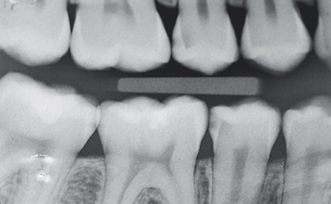 Dental X-ray showing multiple molars with one molar having a visible filling