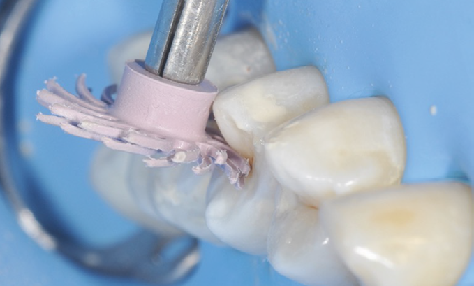 Dental polishing tool with a pink rubber cup polishing a molar tooth isolated by a blue dental dam