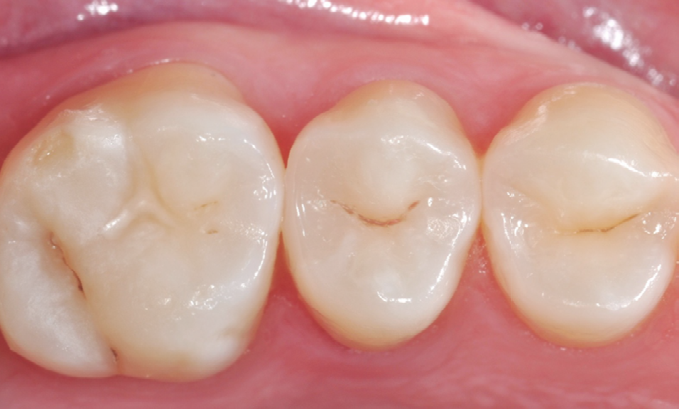 Close-up of three molars with visible dental fillings on the middle and right teeth