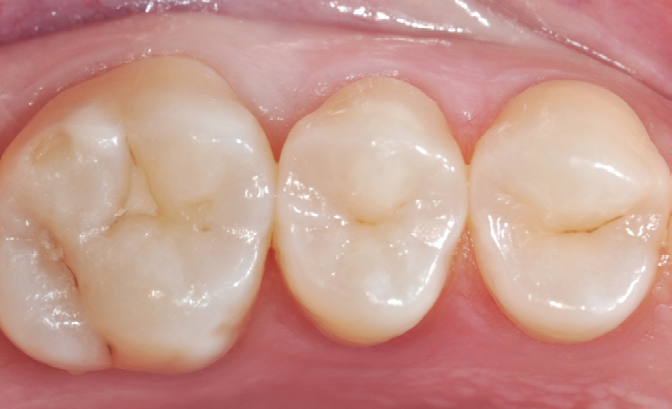 Close-up of three molars with dental fillings in the grooves and pits