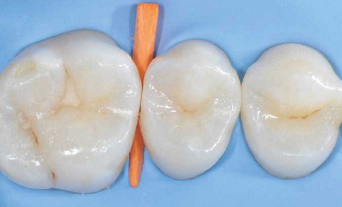 Three molar teeth with a wooden wedge placed between the first and second tooth
