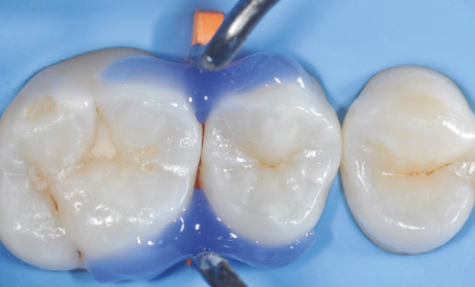 Close-up of two molars with dental dam and metal clamps in place