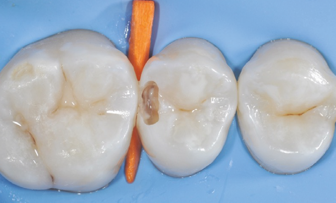 Close-up of three molars with a dental wedge placed between the first and second molars and a cavity prepared in the second molar