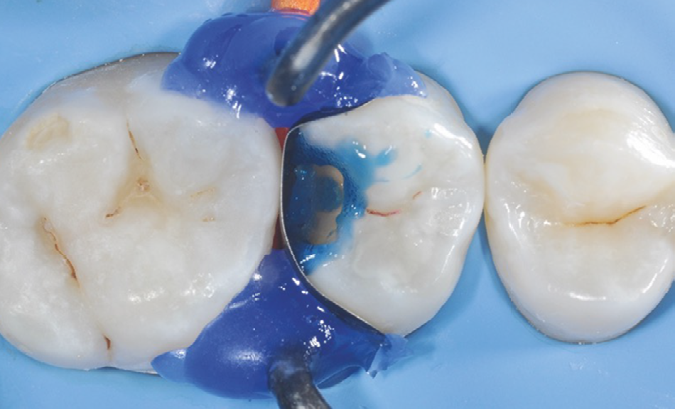 Close-up of three molars with dental dam and blue etching gel applied to the middle tooth