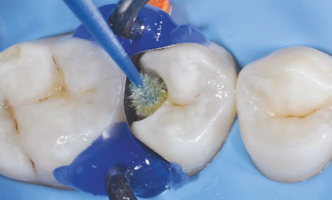 Close-up of a dental procedure showing a brush applicator inside a cavity of a molar tooth isolated with a blue dental dam