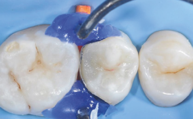 Close-up of three molars with dental dam and blue dental material applied around the middle tooth