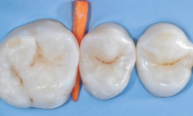 Three molar teeth isolated with a blue dental dam and an orange wedge between the first and second molars