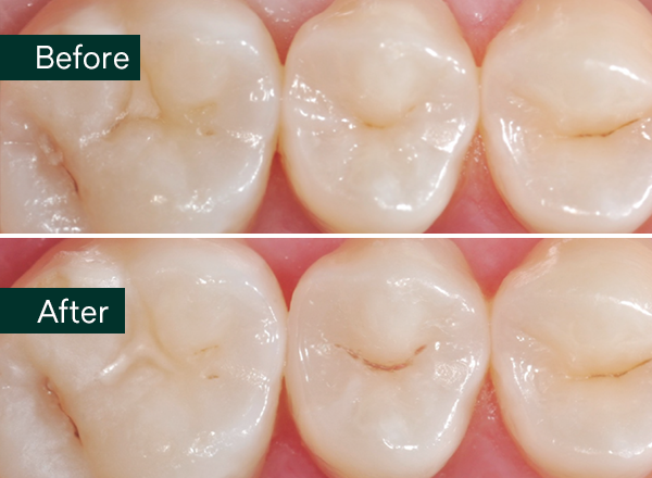 Close-up comparison of molars showing a before and after view with slight surface differences