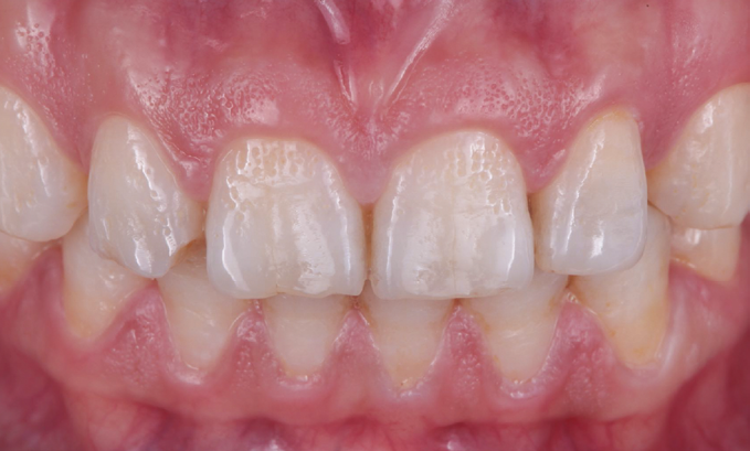 Close-up of upper front teeth showing uneven edges and slight spacing between some teeth