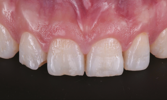 Close-up of upper front teeth showing natural texture and slight spacing between some teeth