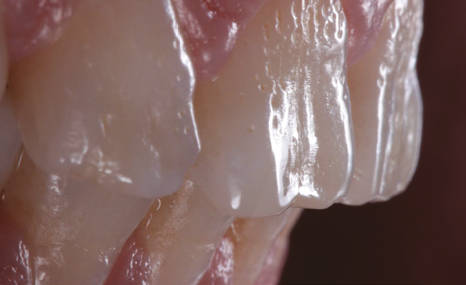Close-up of a tooth with visible enamel surface and adjacent gum tissue