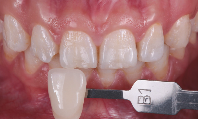 Close-up of upper front teeth with a dental shade guide labeled 'B1' held next to a central incisor