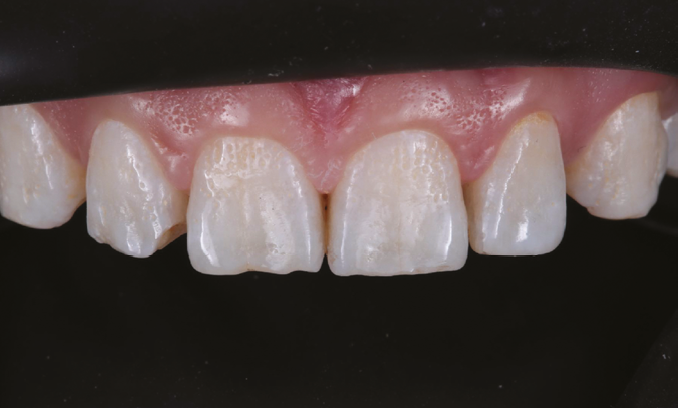 Close-up of upper front teeth showing uneven edges and slight spacing between some teeth