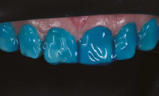 Close-up of upper front teeth covered with blue dental impression material