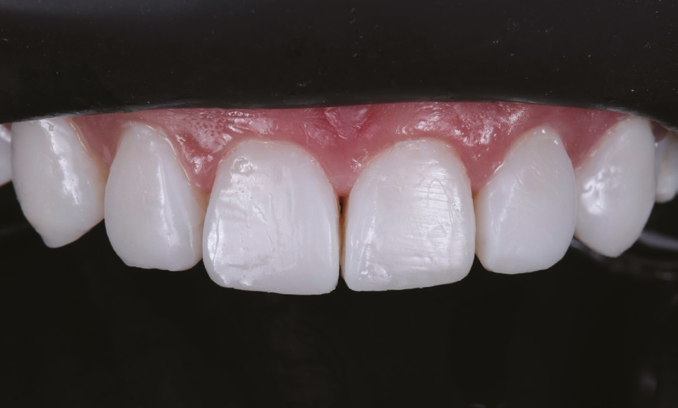 Close-up of upper front teeth showing dental restorations on two central incisors with visible texture and slight color variation