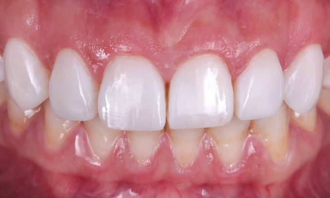 Close-up of upper front teeth and gums showing natural teeth with slight spacing and healthy pink gums