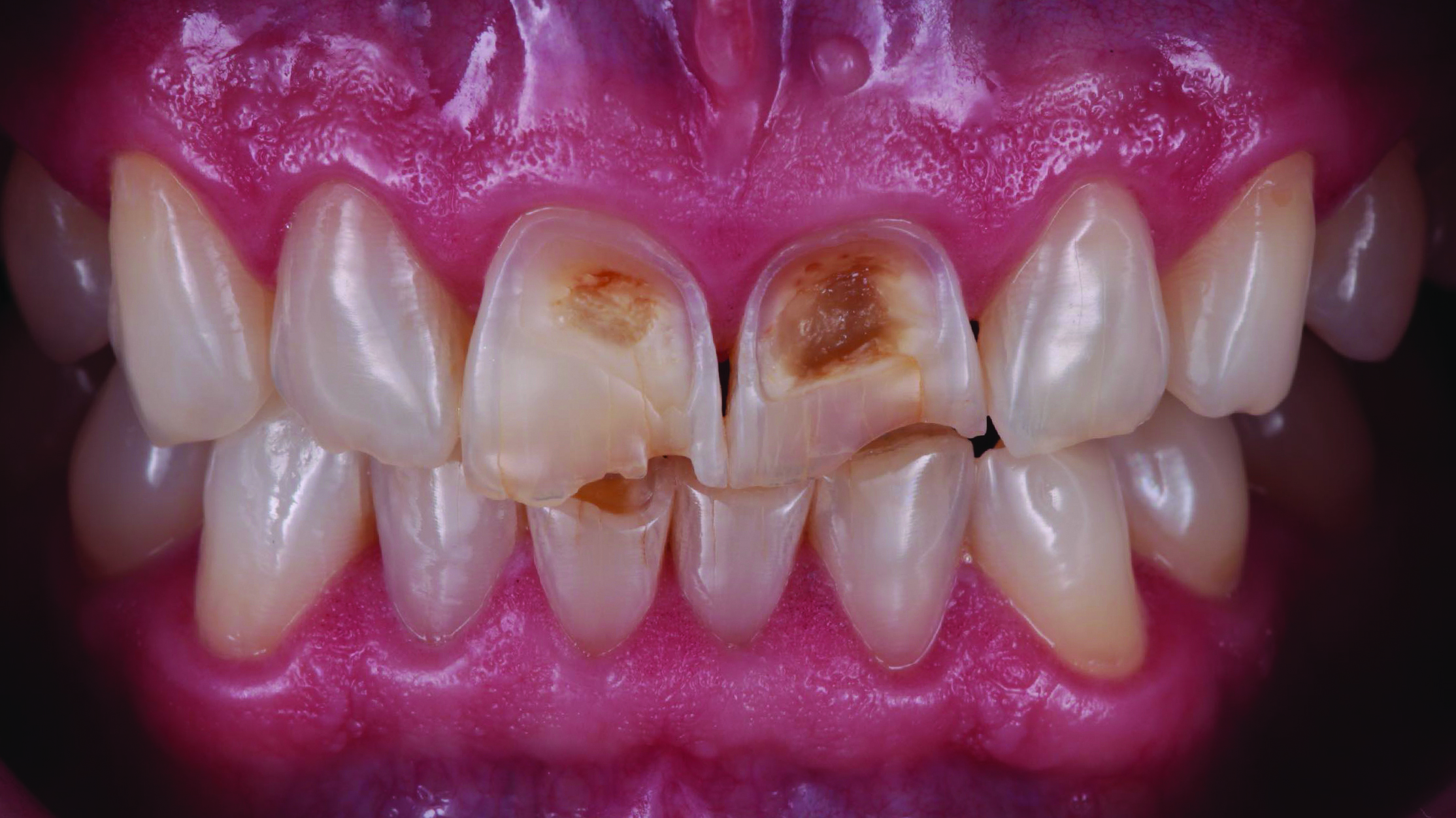 Close-up of upper and lower front teeth showing dental decay and damage on two upper central incisors