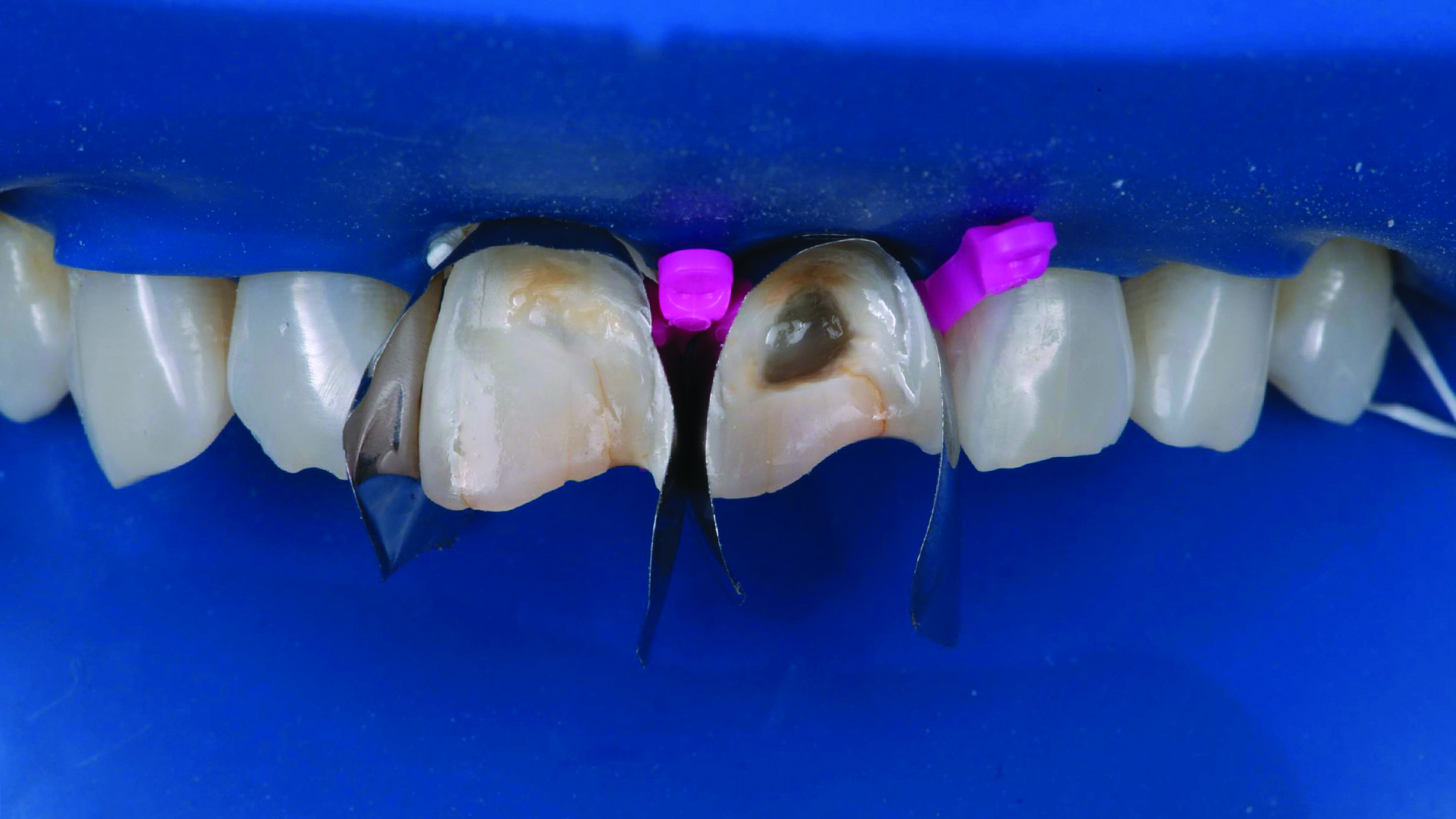 Close-up of upper front teeth with dental matrix bands and pink wedges placed between some teeth