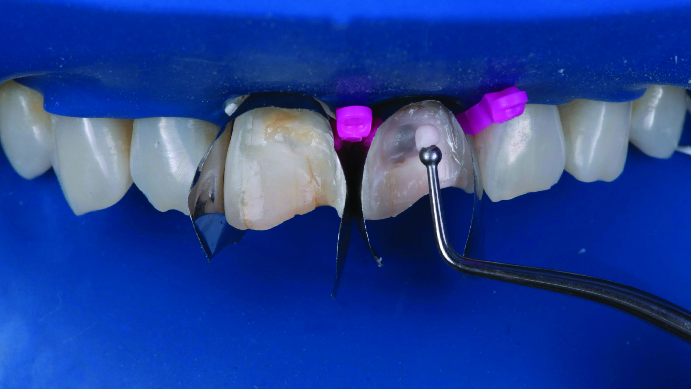 Close-up of upper front teeth with dental matrix bands and a dental tool positioned near a tooth