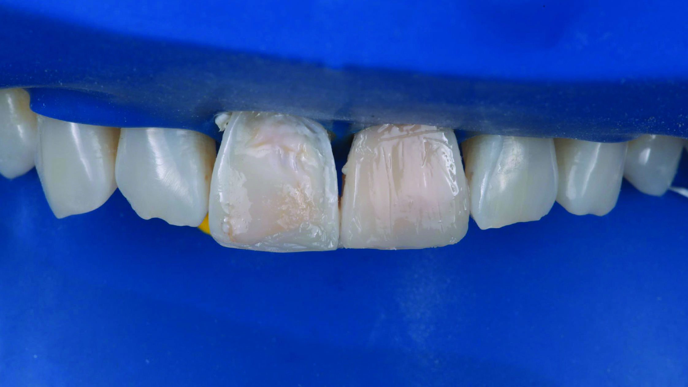 Close-up of upper front teeth with two central incisors showing dental treatment or restoration work