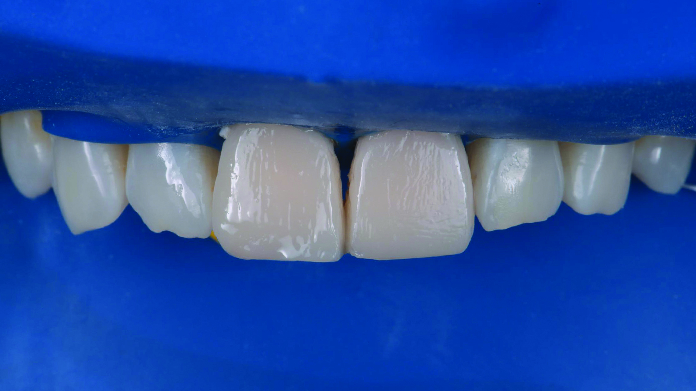 Close-up of upper front teeth with two central incisors covered by dental veneers or crowns