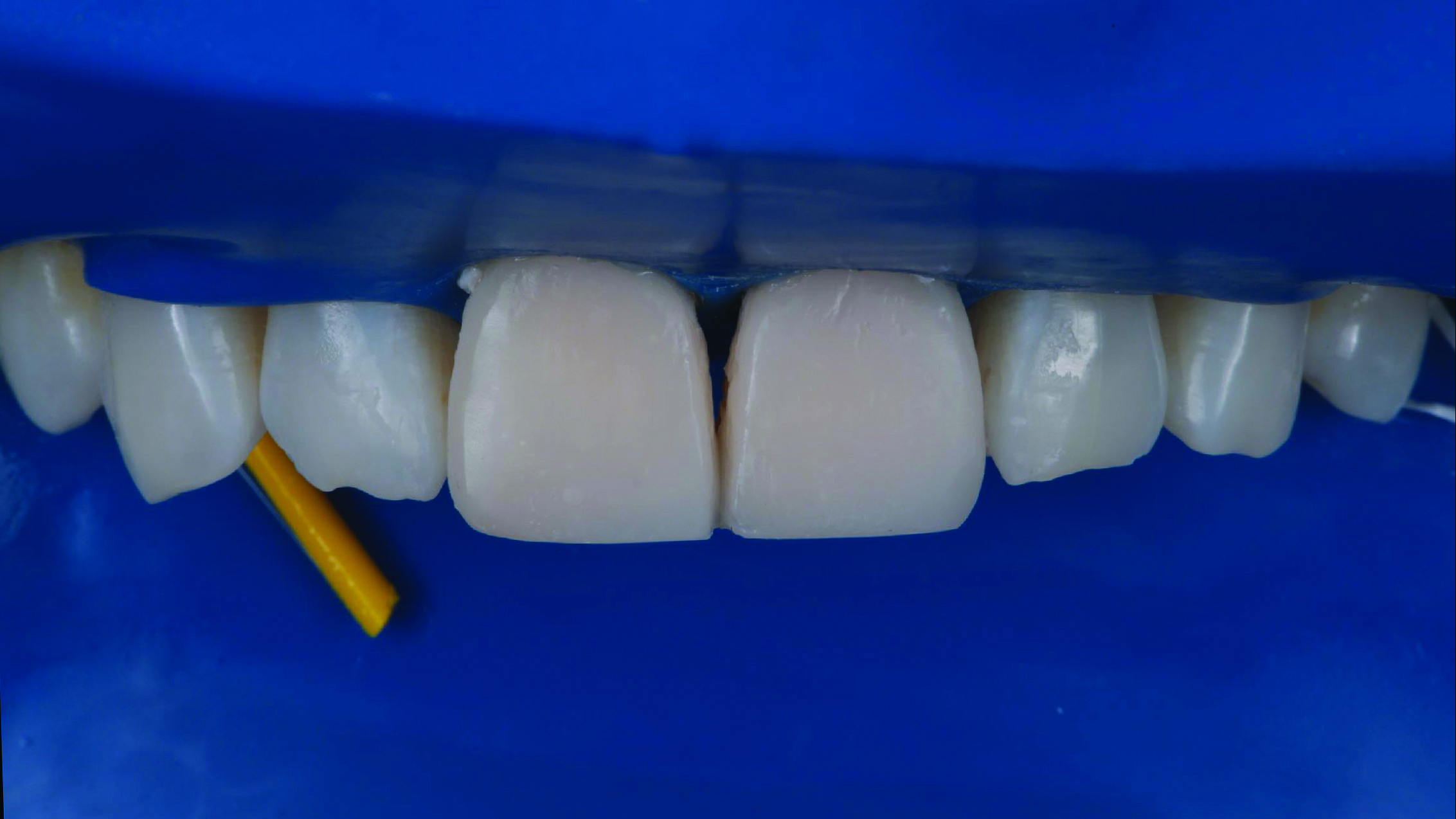 Close-up of upper front teeth with a dental wedge placed between two teeth on the left side
