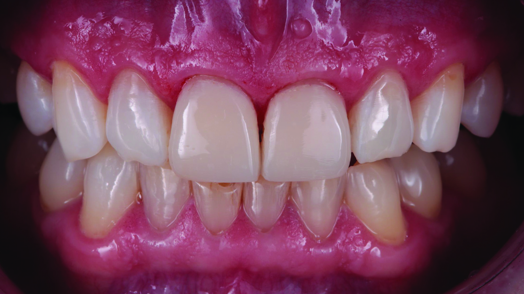 Close-up of upper and lower front teeth with visible gums