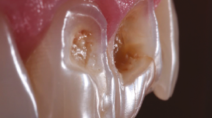 Close-up of two upper front teeth showing visible cavities and enamel damage