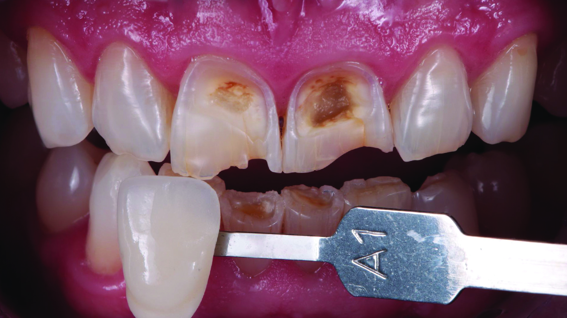 Upper front teeth with visible decay and damage, a dental shade guide labeled 'A1' held next to a damaged tooth