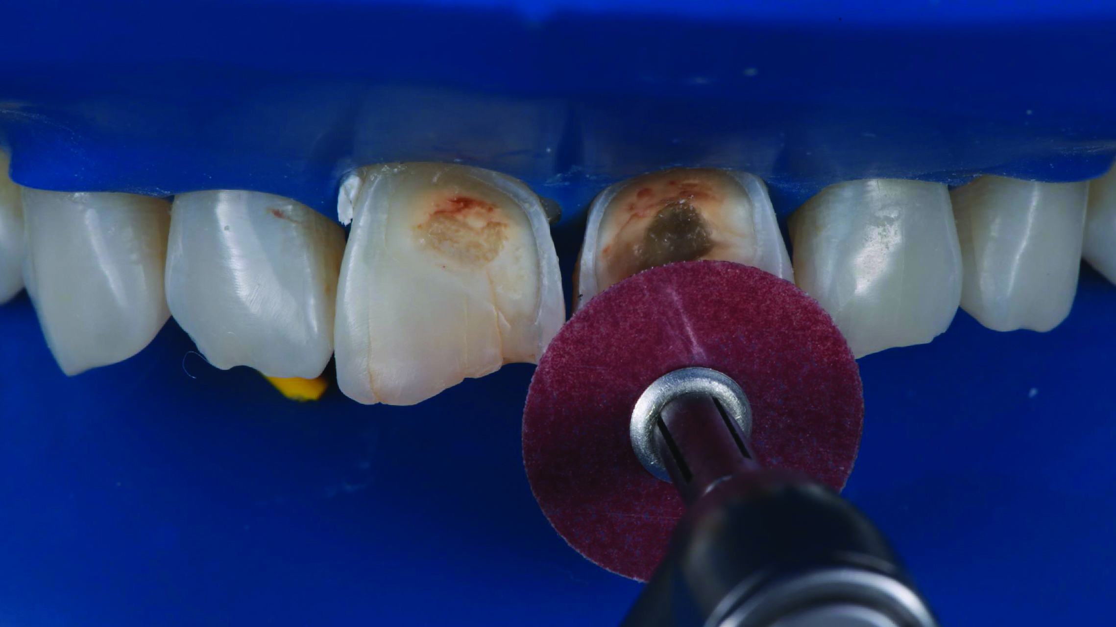 Close-up of upper front teeth with dental drill polishing a discolored tooth