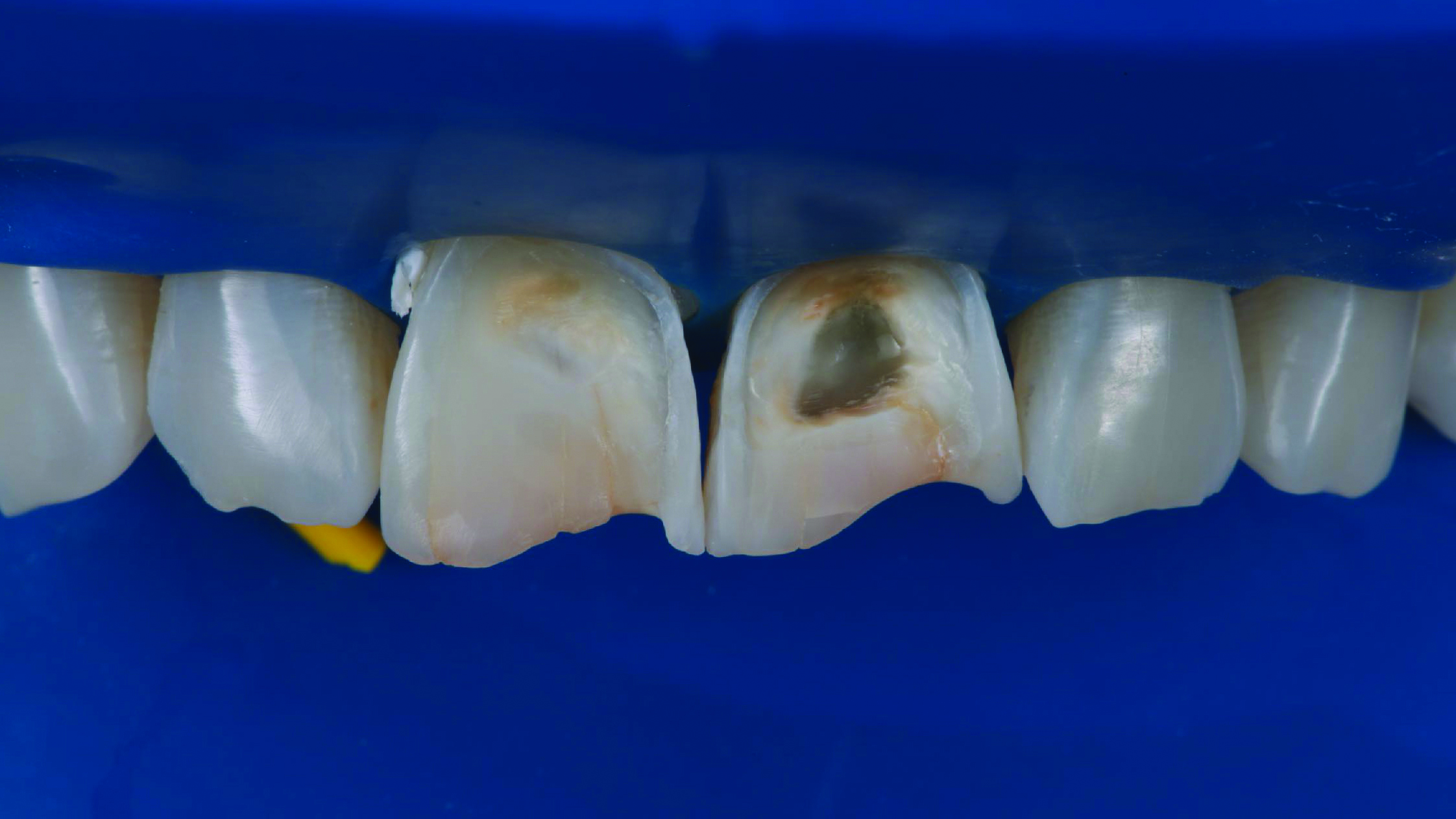 Close-up of upper front teeth showing one tooth with a large dark cavity and another with discoloration
