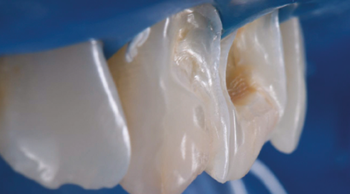 Close-up of three human teeth with visible dental plaque and discoloration on the middle tooth