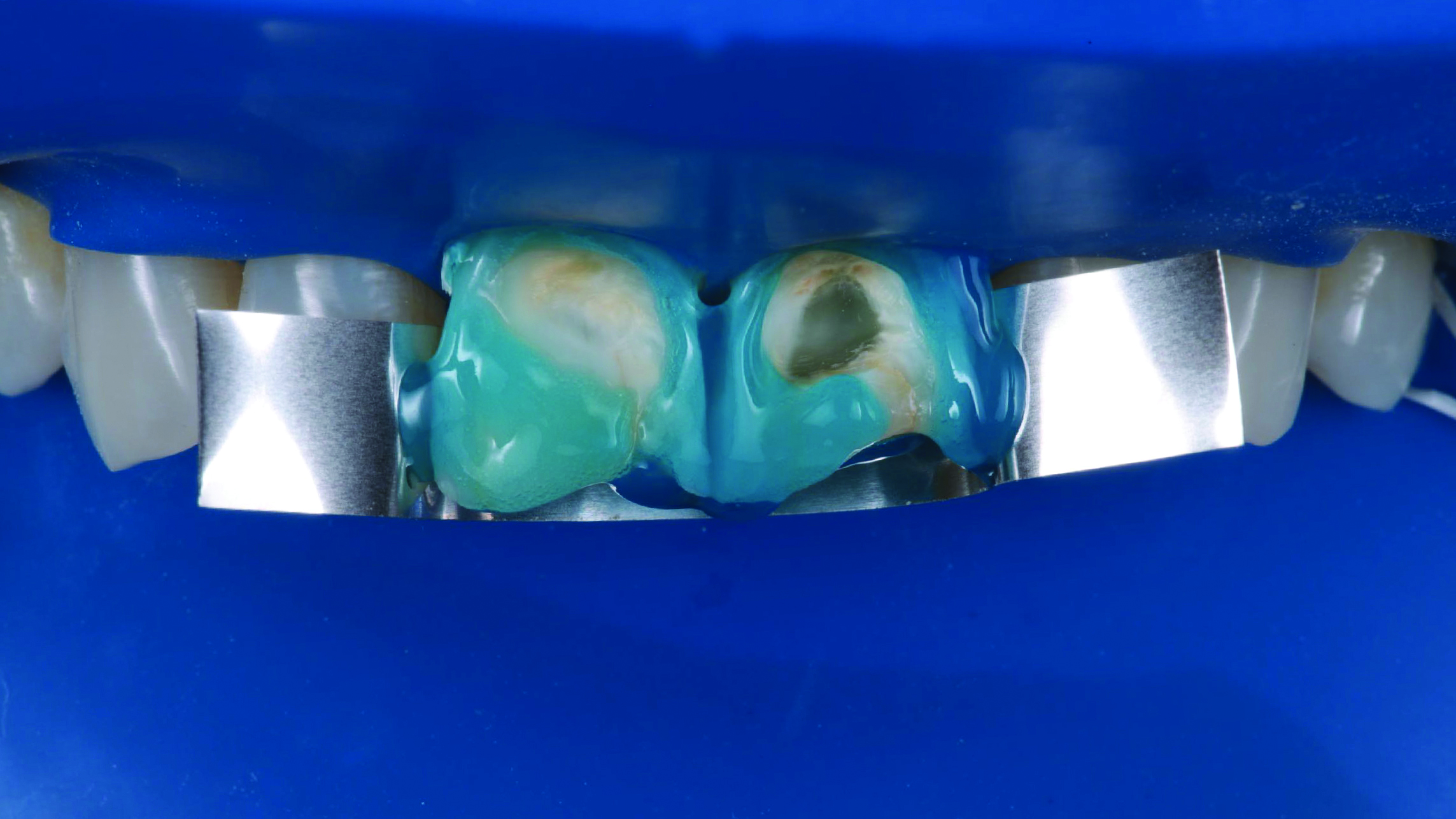 Close-up of two teeth with blue dental material applied and metal dental matrix bands around them