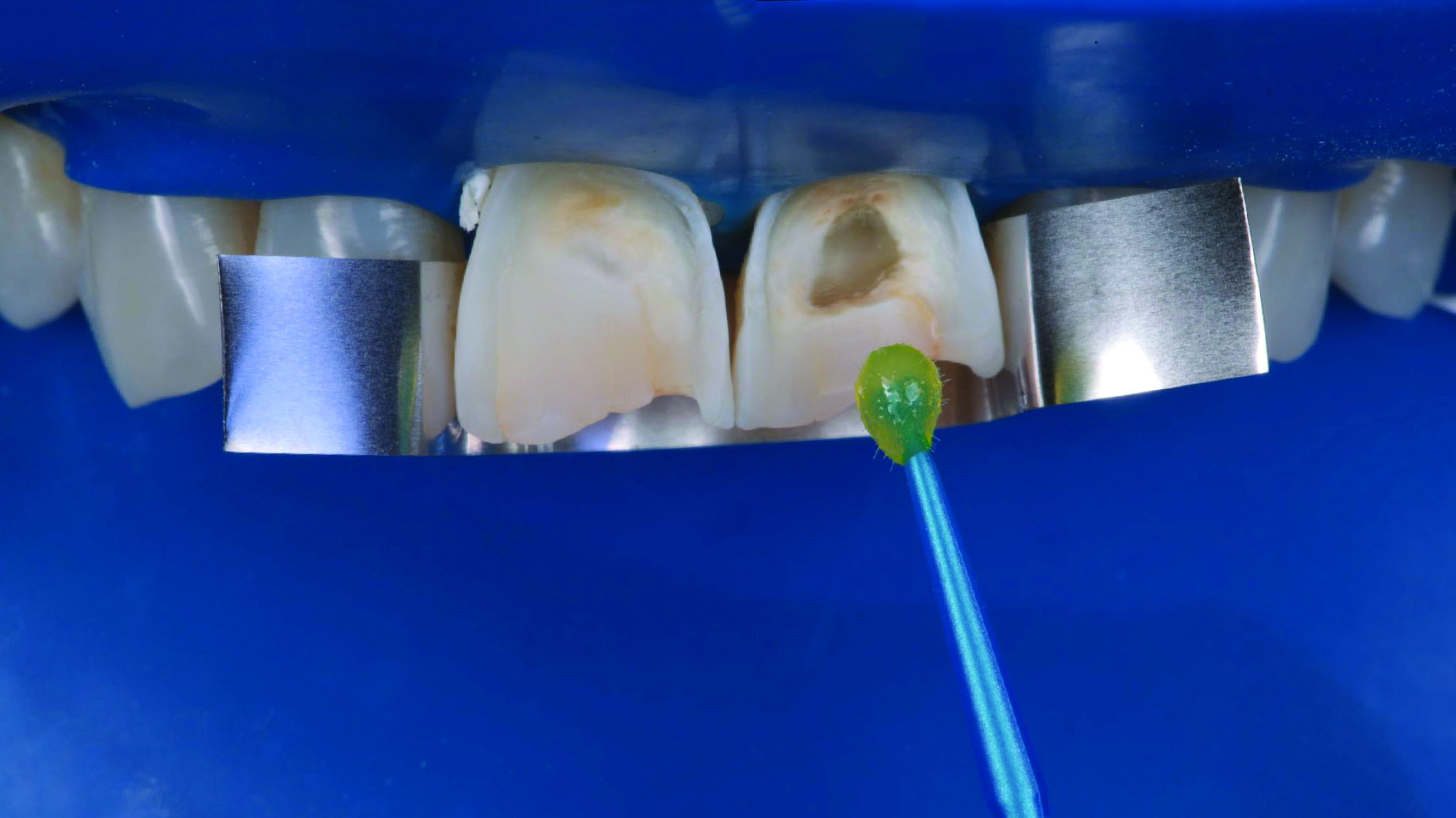 Close-up of upper front teeth with dental matrix bands on adjacent teeth and a dental applicator applying material to a prepared tooth surface