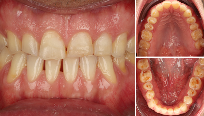 Close-up of upper and lower teeth showing wear and discoloration with two smaller images of upper and lower dental arches from inside the mouth
