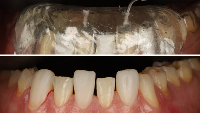 Close-up of upper front teeth with dental appliance and lower front teeth showing gum recession and tooth wear