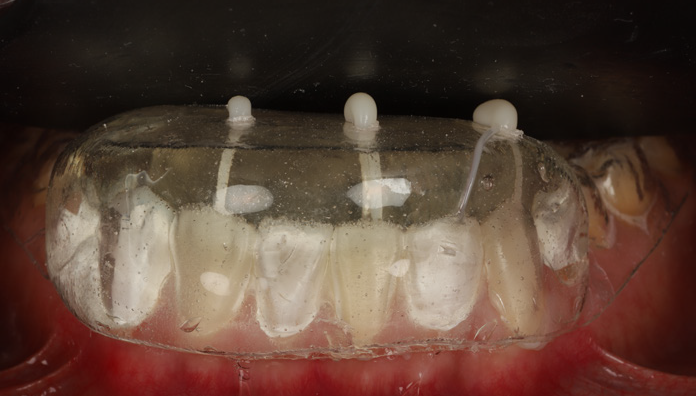 Dental impression tray with visible teeth and three vertical posts inside the mouth