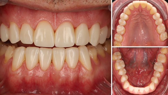 Close-up of upper and lower teeth showing slight crowding and mild gum recession with two smaller images showing upper and lower dental arches from above and below