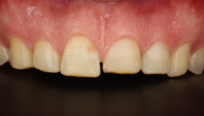 Close-up of upper front teeth showing discoloration and wear on the central incisors