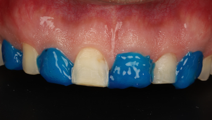 Close-up of upper front teeth with blue dental material applied to some teeth and one central tooth partially covered