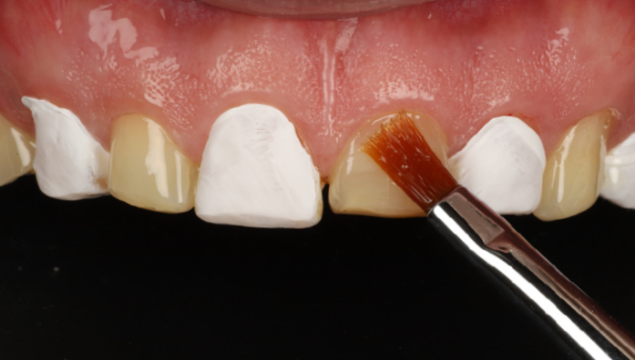 Close-up of upper front teeth with white dental material applied and a brush touching one tooth