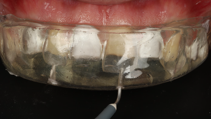 Close-up of a dental mouthguard fitted over upper teeth with a dental scaler tool positioned underneath